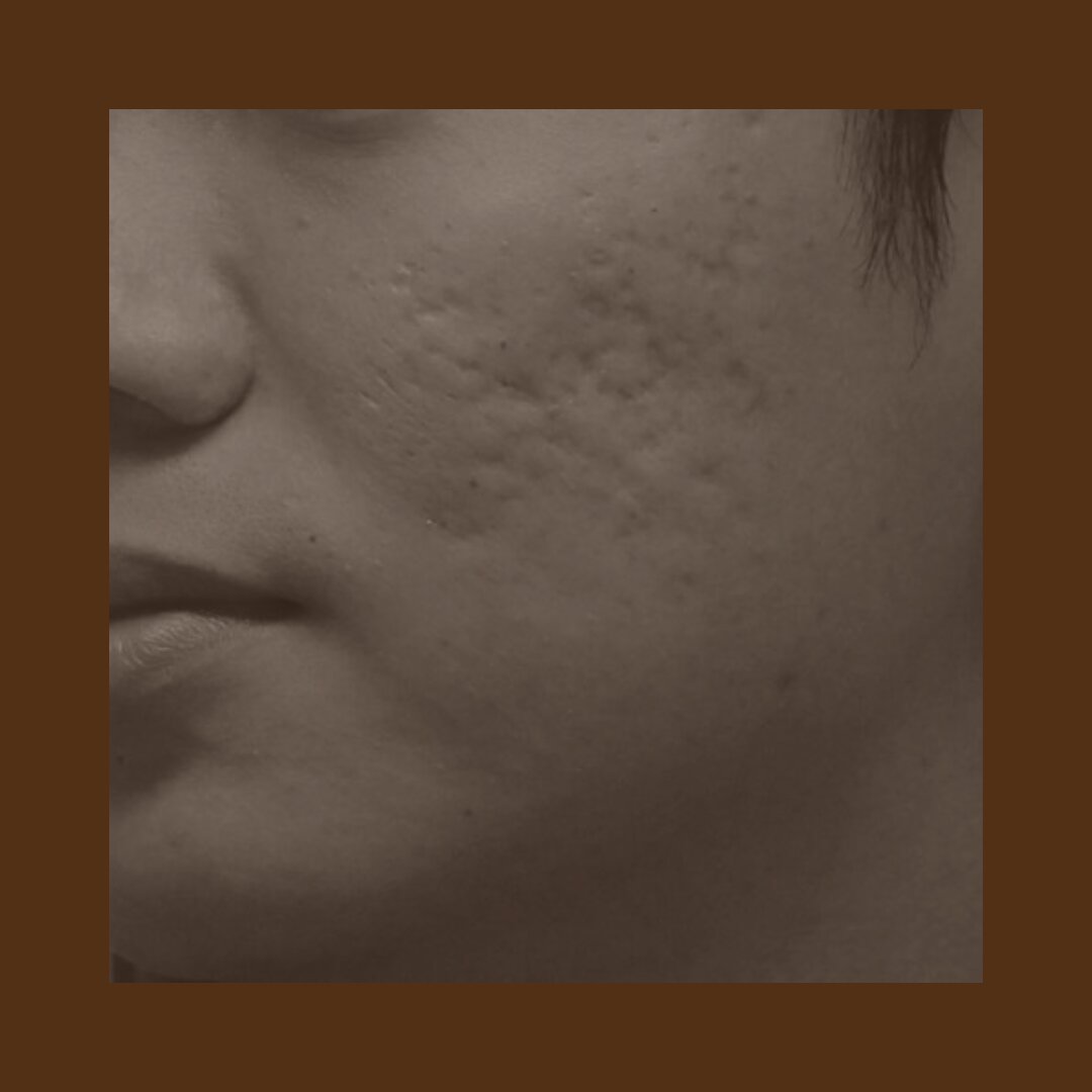 cicatricesymarcasdeacne